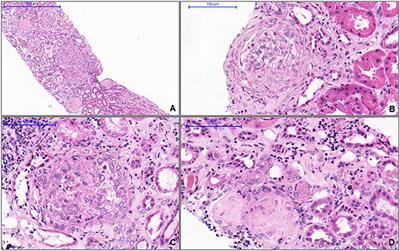 ANCA-associated vasculitis following Oxford-AstraZeneca COVID-19 vaccine in Brazil: Is there a causal relationship? A case report